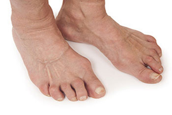 Arthritic foot and ankle care treatment in the Orleans County, LA: New Orleans, St. Bernard County: Chalmette, Plaquemines Parish: Bella Chasse and Jefferson County: Metairie, Kenner, Harvey, Terrytown, Gretna, Woodmere, Waggaman, Timberlane, Harahan areas