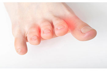 Mortons' neuroma specialist in the Orleans County, LA: New Orleans, St. Bernard County: Chalmette, Plaquemines Parish: Bella Chasse and Jefferson County: Metairie, Kenner, Harvey, Terrytown, Gretna, Woodmere, Waggaman, Timberlane, Harahan areas