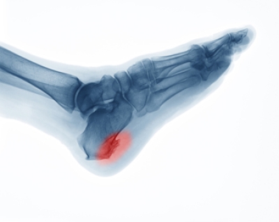 Heel Spurs From Calcium Build-Up