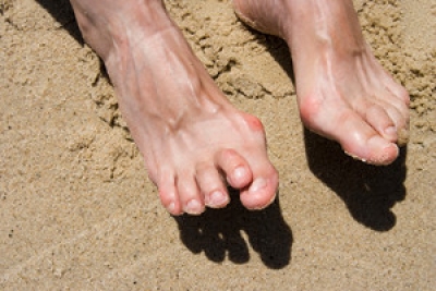 Consequences of Non-Treatment of Hammertoe